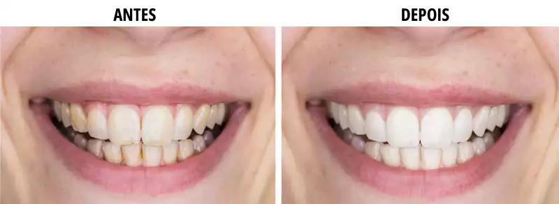 Clareador dental v34 funciona: Confira