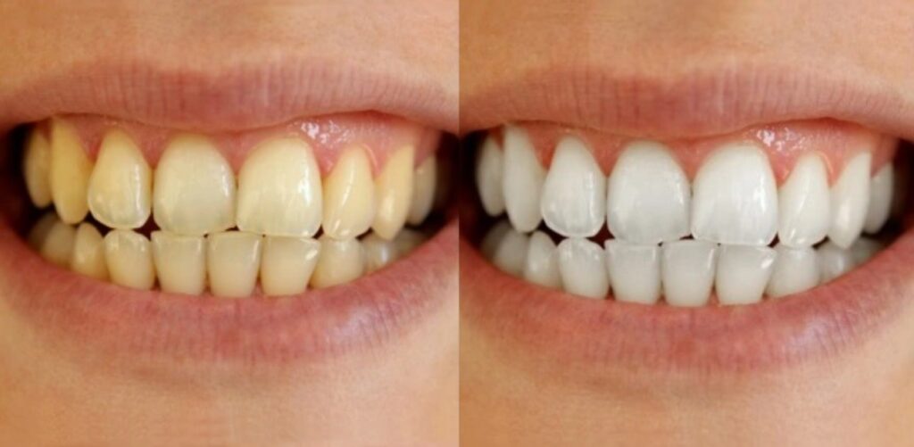 Tiras clareadora dental v34 funciona? Minha experiência