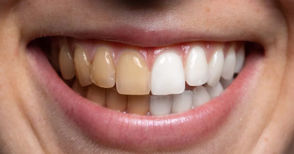 Fita clareadora dental roxa é confiável? Confira